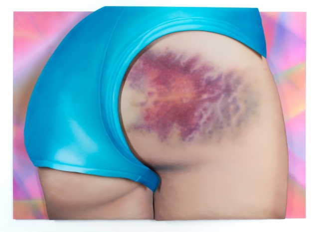 I Got a Really Beautiful Bruise on My Bum, Do You Want To See a Pic It Has 12 Colours And Is the Size of My Head! by Riikka Hyvönen